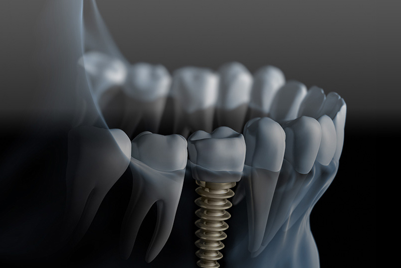 STUDIO DENTISTICO SARDELLA - TERAPIE - IMPLANTOLOGIA